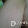 儿童血小板减少性紫癜的治疗