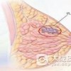 生乳头汗管囊腺瘤应该如何预防