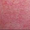 泛发性特发性毛细血管扩张如何预防