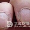 药物反应性甲病的症状有哪些