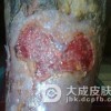 臁疮腿患者哪些食物不能吃