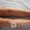 固定性药疹的引发药物是什么