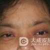 过敏性眼睑皮肤炎的饮食保健