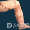 孢子丝菌病在早期的症状有哪些