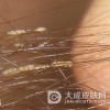 腋毛癣菌病的病症知识