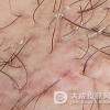 腋毛癣菌病的治疗方法