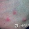 被蚊子叮咬后有哪些去痒方法