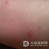 宝宝被蚊子叮咬后的注意事项