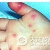 宝宝得了小儿紫斑湿疹综合征怎么办