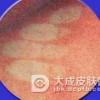 小儿白细胞黏附分子缺陷Ⅱ型的预防