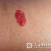 蔓状血管瘤用什么方法可以治疗