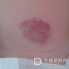 面部蔓状血管瘤该怎么办呢