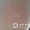 夏季如何防止花斑癣