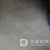 花斑癣要如何预防呢