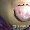 如何预防舌扁平苔藓