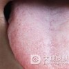 舌扁平苔藓是一种什么病