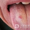 舌扁平苔藓的发病原因有哪些