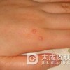 寻常疣的预防方法有哪些
