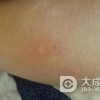 丘疹状荨麻疹到底会不会危害生命
