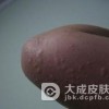 什么是丘疹性荨麻疹病