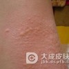 丘疹性荨麻疹应如何用药