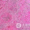 结节性硬化症的症状类型有什么