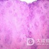 结节性肝硬化会出现的症状有什么