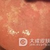 中医预防护理疔疮措施