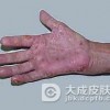 葡萄球菌性烫伤样皮肤综合征症状表现