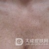 瑞尔黑变病的原因是什么