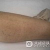 丘疹紫癜性手套和短袜样综合征的饮食保健