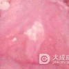 口腔粘膜白斑病的病因是什么