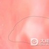 口腔粘膜白斑病的相关因素