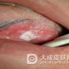 什么是口腔粘膜白斑病