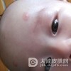 婴儿痤疮的原因是什么呢