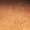 毛发红糠疹病发的症状有哪些？