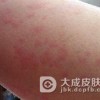 肾上腺能性荨麻疹知识