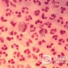 淋球菌感染会引发什么疾病