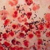 淋球菌感染有何临床表现