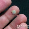 面部肉芽肿的病人平时要注意什么