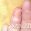 甲内型甲真菌病的症状有哪些