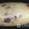 皮下脂膜炎性T细胞淋巴瘤如何鉴别诊断