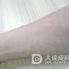 网状青斑如何预防