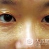 眼睛周围长汗管瘤有什么影响吗