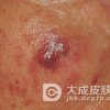 治疗寻常狼疮的手法