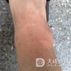 怎样预防急性蜂窝组织炎