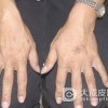 得了风搔痒如何治疗