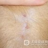 身体上有痒点怎么治疗