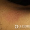 痒点需要关注什么