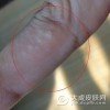 痒点怎么治疗